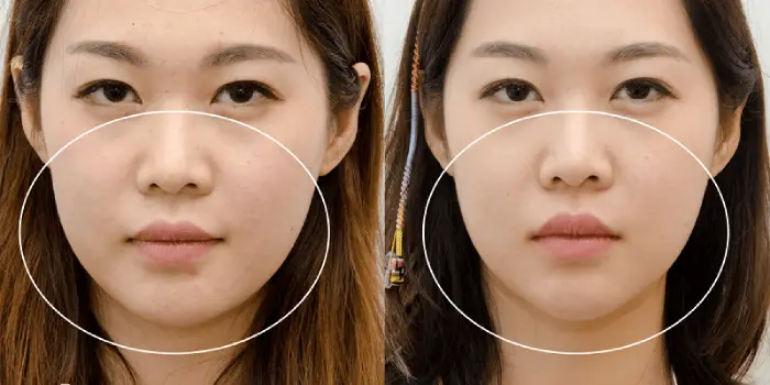 چه کسانی برای تزریق کانتورینگ صورت گرد با ژل مناسب هستند؟