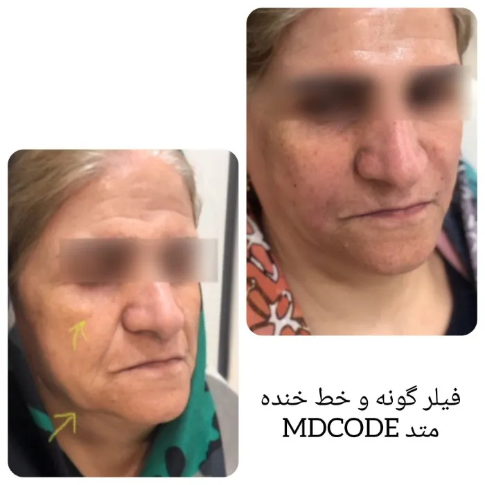 کانتورینگ صورت چیست؟