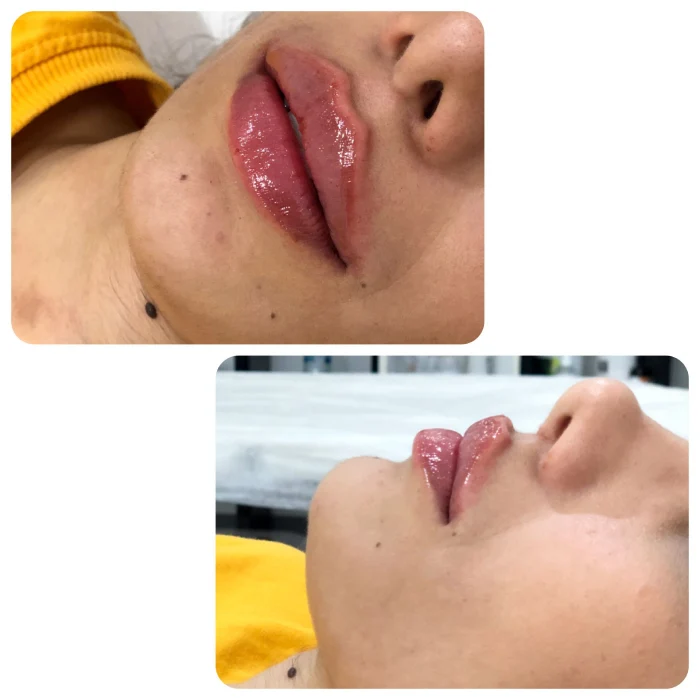 بزرگ شدن لب برای همیشه