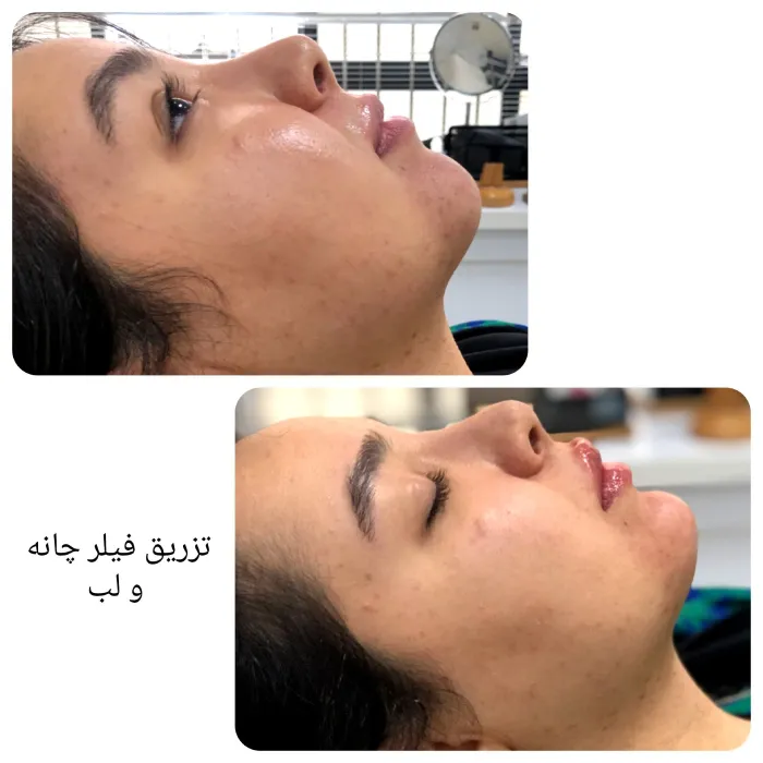 مزایای زاویه سازی صورت با ژل نسبت به سایر روشها