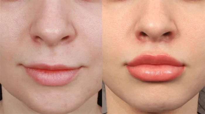 جراحی لیفت لب یا سانترال لب