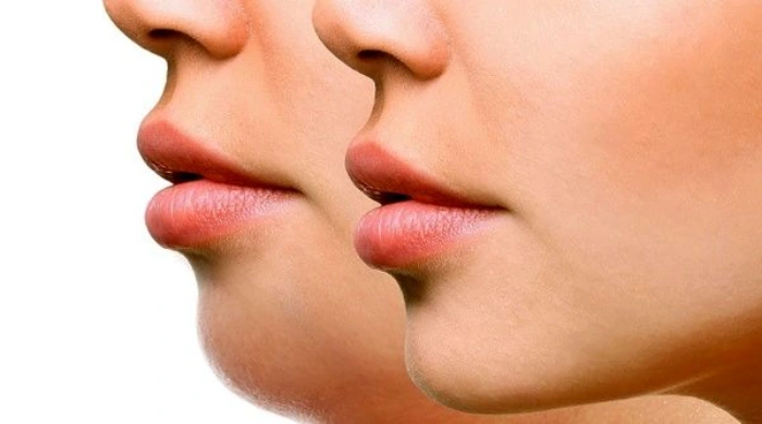 رفع غبغب بدون جراحی؛ همه روشهای مؤثر و جدید در سال ۲۰۲۵