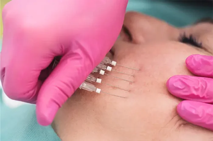 زاویه سازی صورت با نخ روشی نوین برای زیبایی و جوانسازی صورت