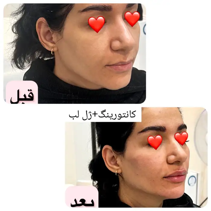 مزایا و معایب کانتورینگ صورت با تزریق چربی
