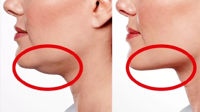 رفع غبغب بدون جراحی؛ همه روشهای مؤثر و جدید در سال ۲۰۲۵