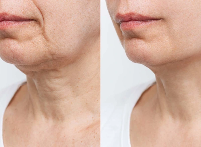 ماندگاری نتایج رفع غبغب بدون جراحی