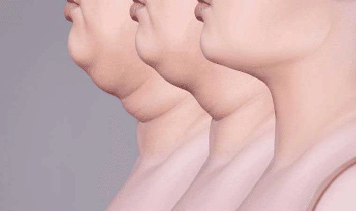 علت ایجاد غبغب چیست؟