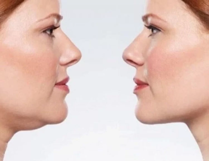 روشهای رفع غبغب بدون جراحی