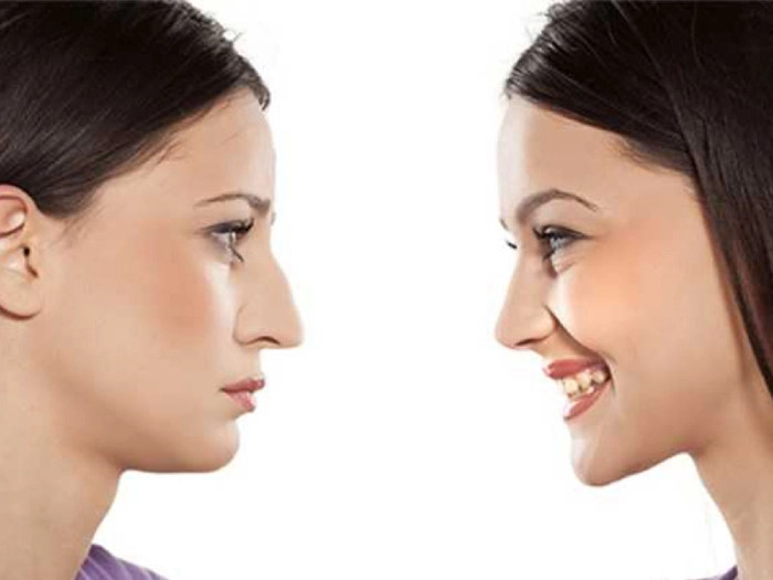 تزریق مزو چربیسوز غبغب (مزوتراپی غبغب)