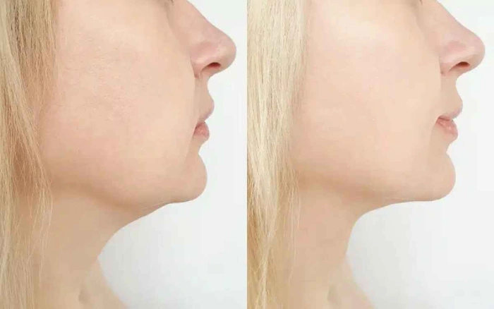 رفع غبغب با دستگاه کویتیشن