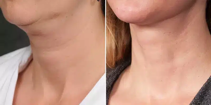 مزایای رفع غبغب بدون جراحی نسبت به جراحی