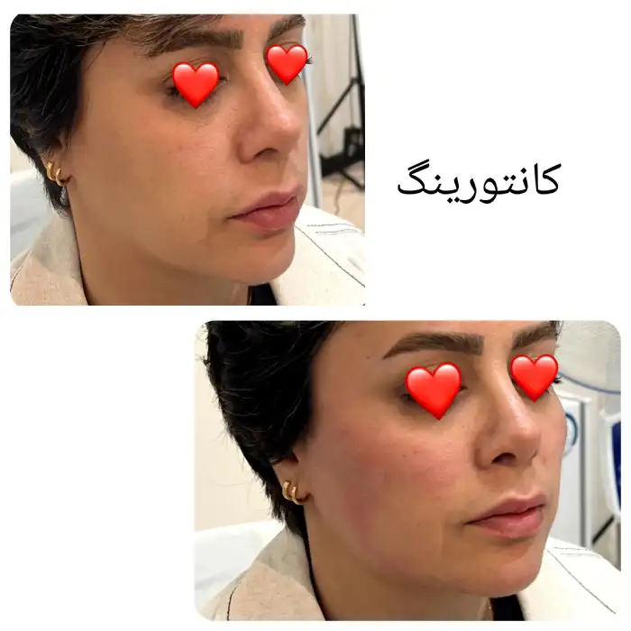 قیمت ژل گونه و چانه در کرج در مقایسه با چربی