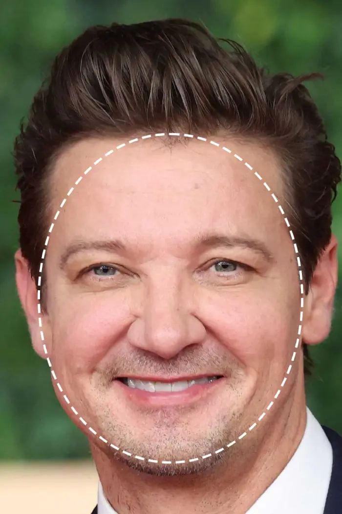 مادلینگ صورت گرد با تزریق ژل چیست؟