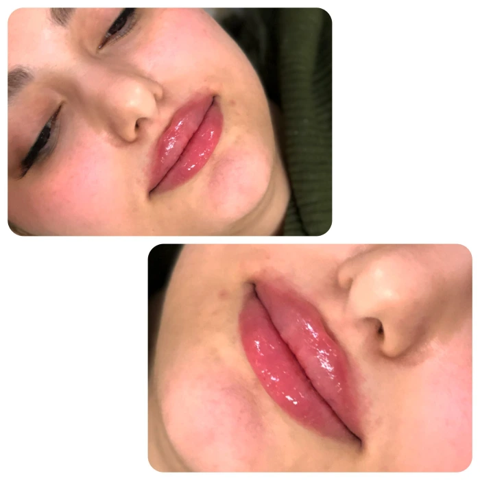 ماساژ برای از بین بردن ژل لب