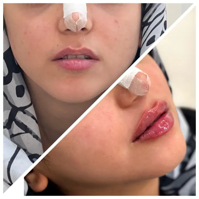 مراقبت های قبل از تزریق ژل اینوسنس یا نورامیس