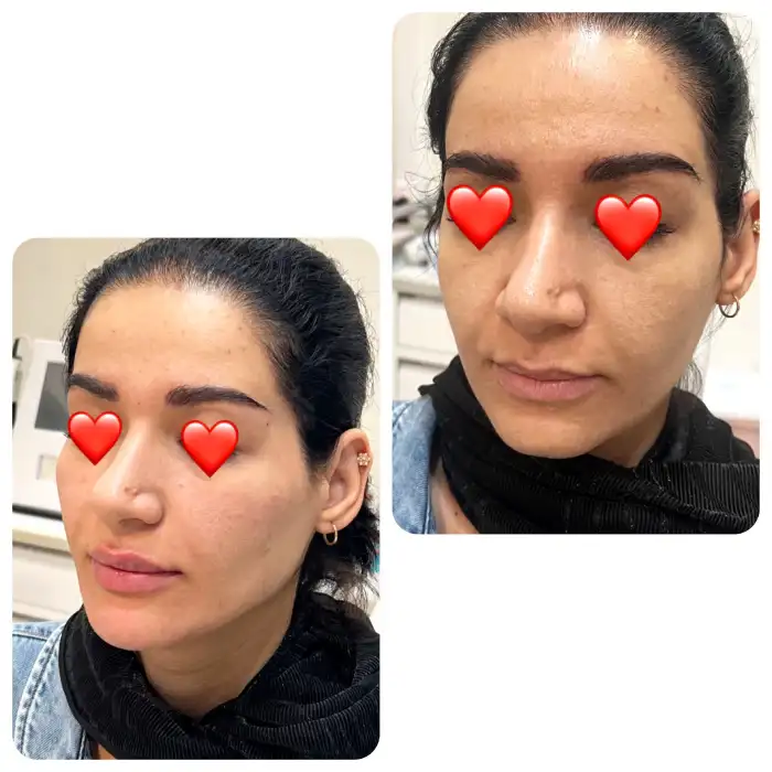 مزایا تزریق ژل به کل صورت