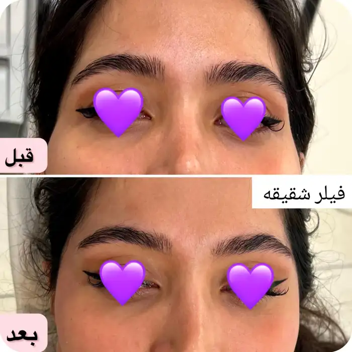 معایب تزریق ژل به کل صورت