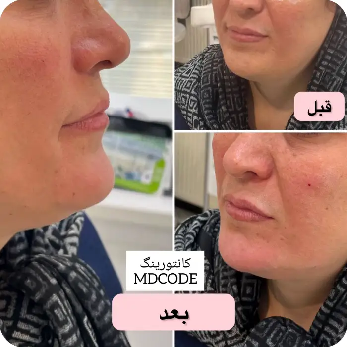 نواحی تزریق برای اصلاح و مادلینگ صورت گرد با ژل