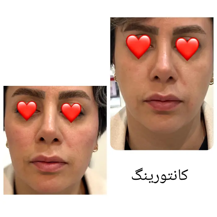 ماندگاری و نتایج کانتورینگ صورت با تزریق چربی