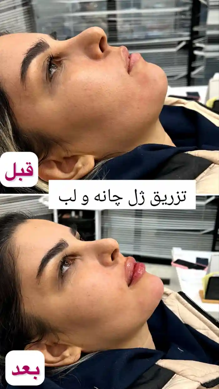 نکات ژل اینوسنس بهتره یا نورامیس، نکات مهم قبل از تزریق ژل