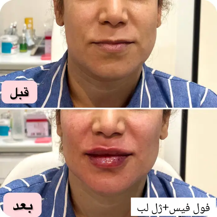 چه عواملی در تعیین هزینه زاویه سازی صورت دائمی نقش دارند؟