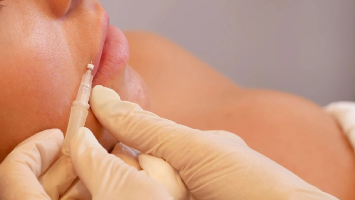 کاشت نخ در لب برای بزرگ شدن لب برای همیشه