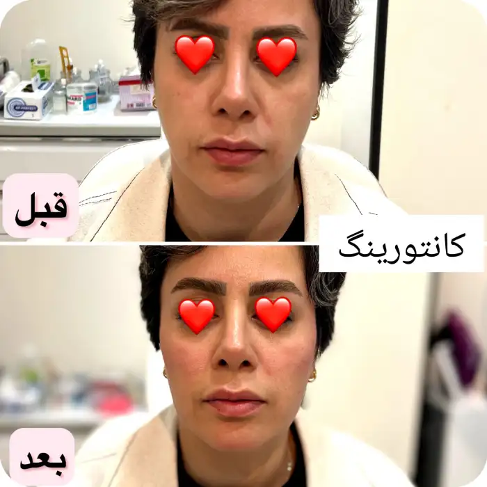 کانتورینگ صورت با تزریق ژل به کل صورت