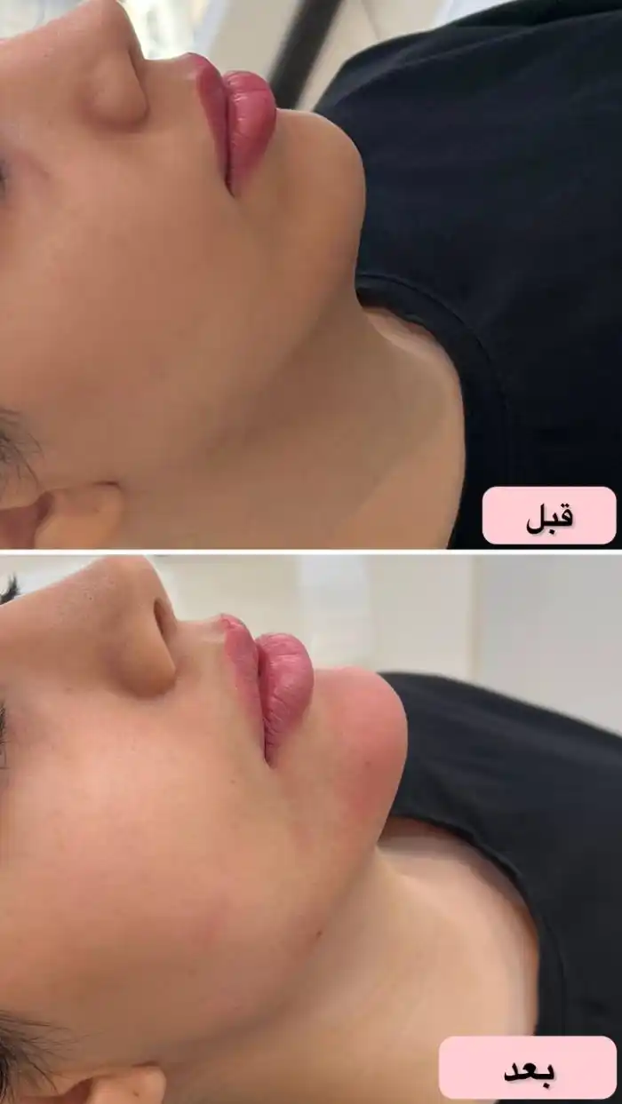 آیا مادلینگ صورت برای همه مناسب است؟