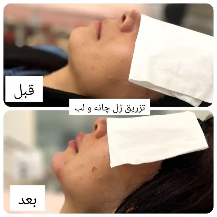 احتمال نکروز چانه بعد از تزریق ژل در چه افرادی بیشتر است؟