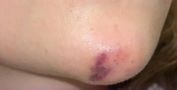 اطلاعات کامل و جامع درباره نکروز چانه بعد از تزریق ژل