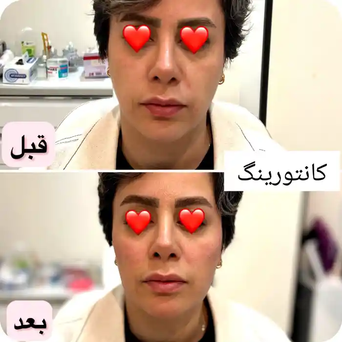 اهمیت و دلیل مشاهده عکس تزریق ژل گونه قبل و بعد