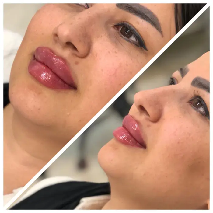 بررسی کامل و علل آنکه آیا بعد از تزریق ژل صورت ورم می کنه