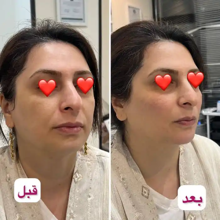 تزریق ژل برای چروک صورت چیست؟