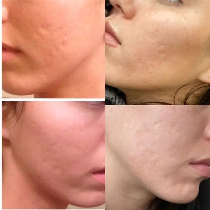 تزریق ژل به جای جوش صورت چیست؟