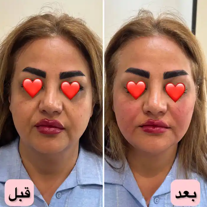 تفاوت مادلینگ صورت با تزریق ژل معمولی در چیست؟