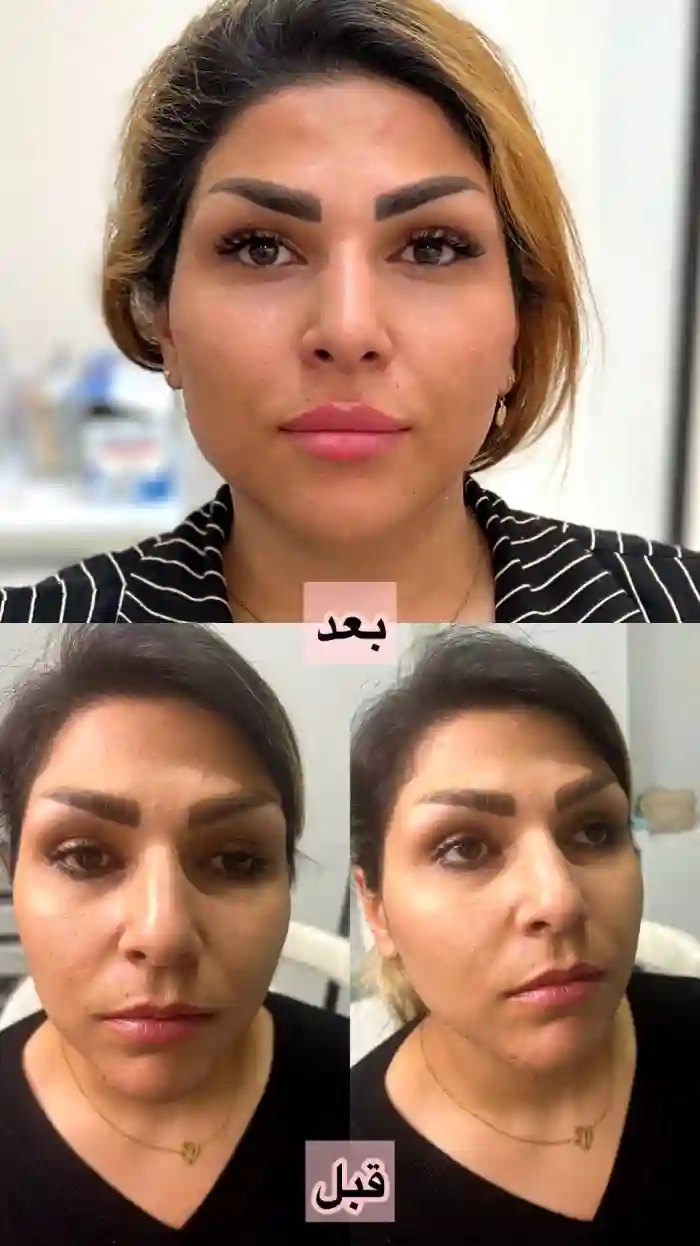 ژل رووفیل چیست و چه ویژگیهایی دارد؟