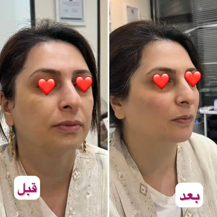 در مادلینگ صورت چه نواحی از چهره تغییر میکند؟