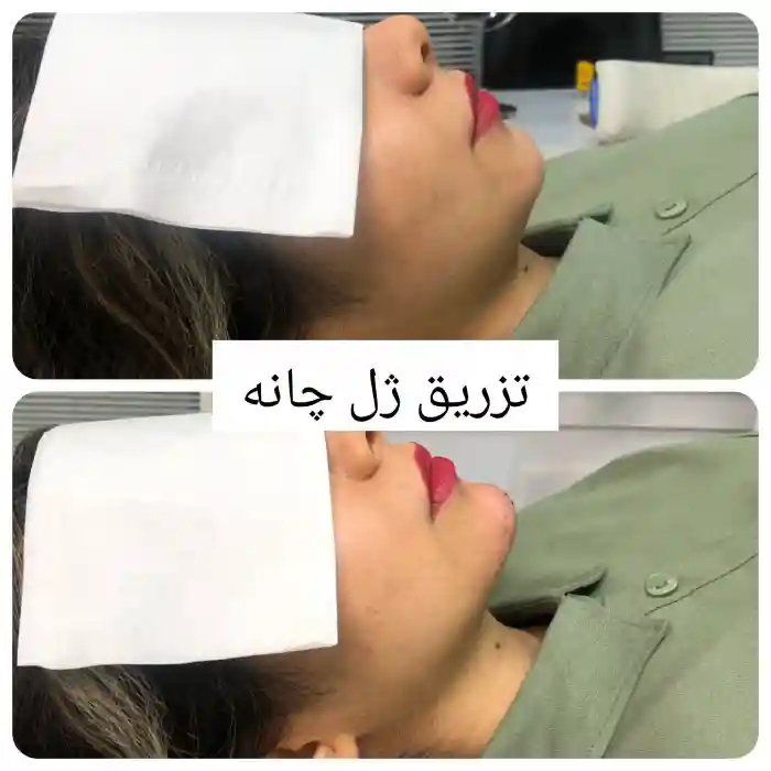 درمان نکروز چانه بعد از تزریق ژل