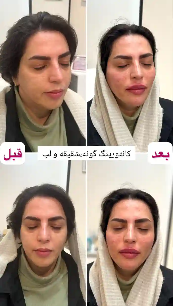 ماندگاری تزریق ژل گونه چقدر است؟