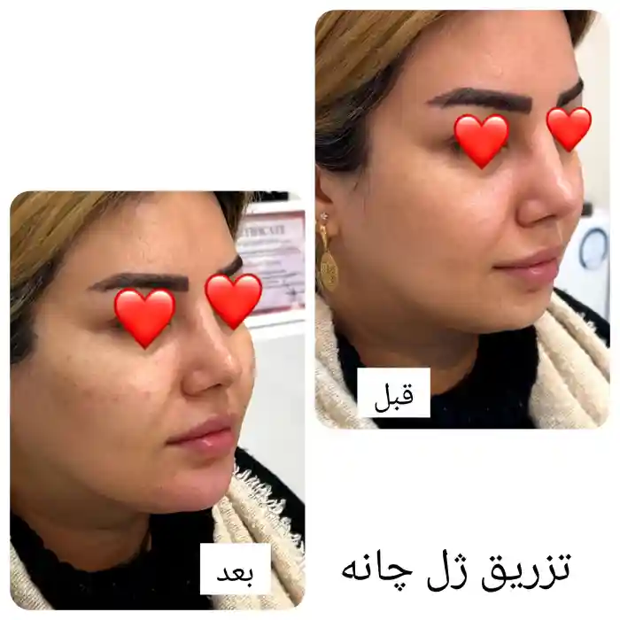 علل نکروز چانه بعد از تزریق ژل چیست؟