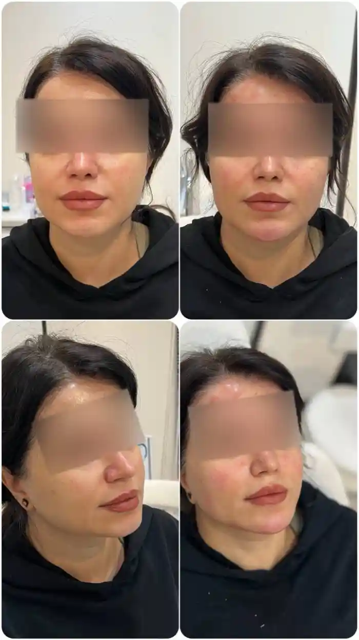 عوارض احتمالی مادلینگ صورت چیست؟