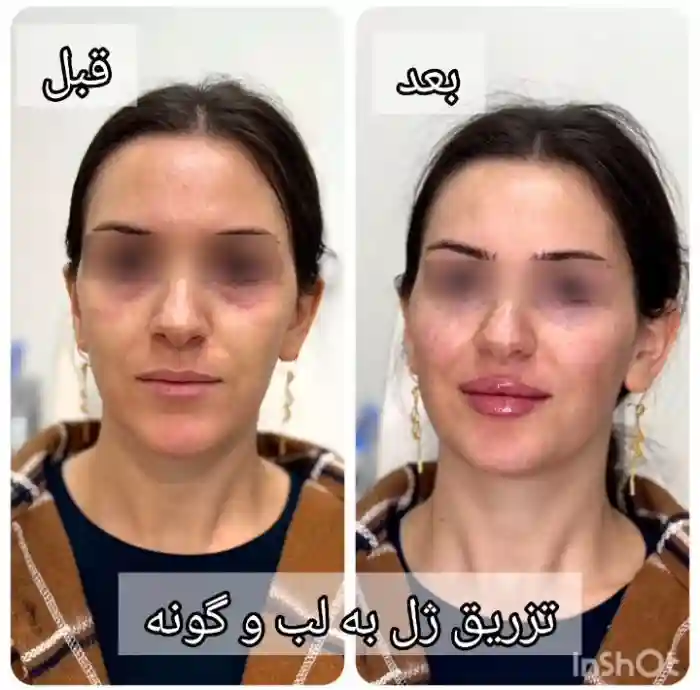 چرا قیمت ژل رووفیل ۱ سیسی در مراکز مختلف تفاوت دارد؟