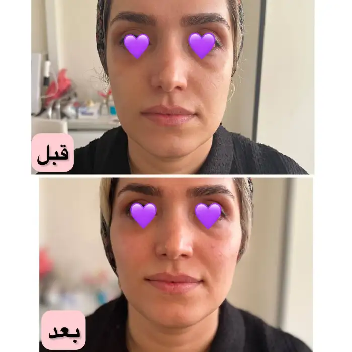 قیمت به روز تزریق ژل مادلینگ صورت 1404