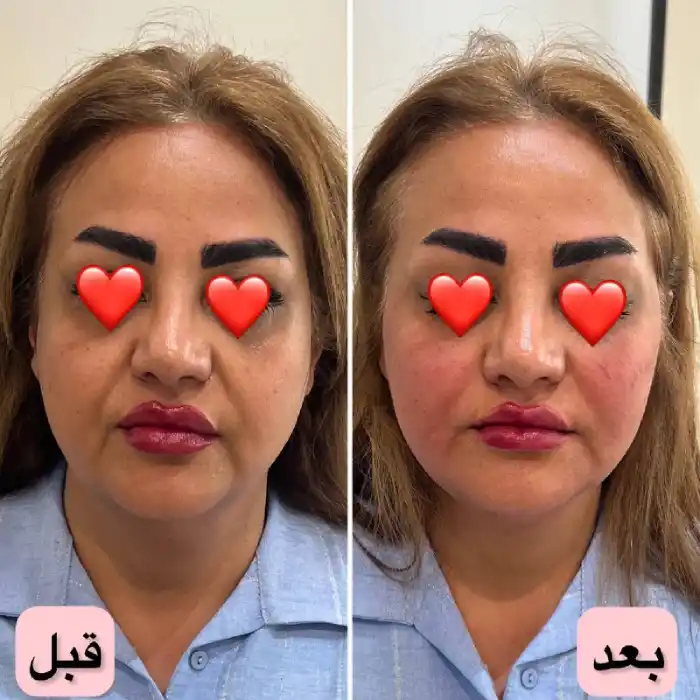 قیمت تزریق ژل برای چروک صورت 1404