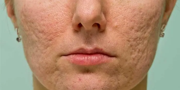 قیمت تزریق ژل به جای جوش صورت 1404