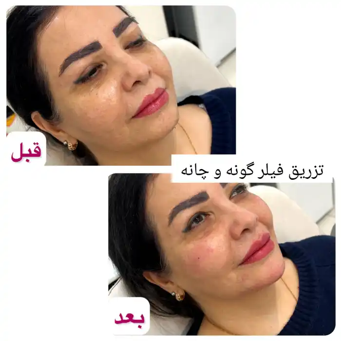 عکس تزریق یک سی سی ژل گونه