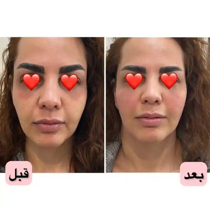 مادلینگ صورت چیست و چرا به این روش زیبایی توجه زیادی شده است؟