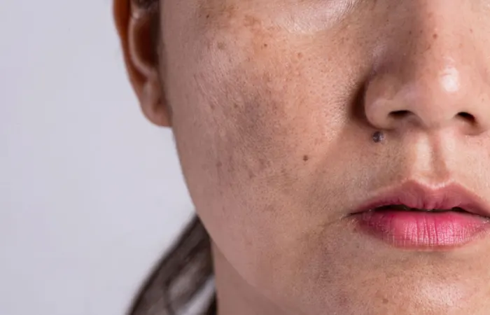 ماندگاری تزریق ژل به جای جوش صورت