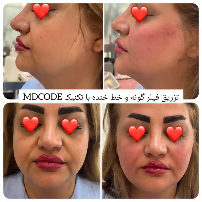 ماندگاری مادلینگ صورت با ژل و قیمت آن