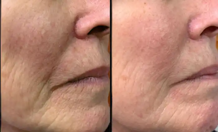 ماندگاری مزوژل جالپرو چقدر است؟